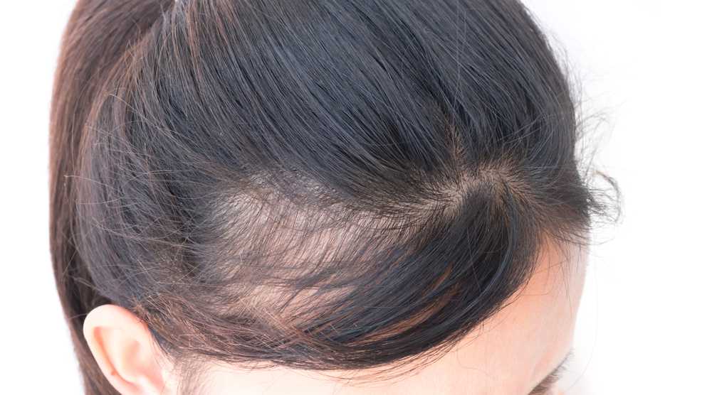 Suy giảm nội tiết tố nữ gây rụng tóc