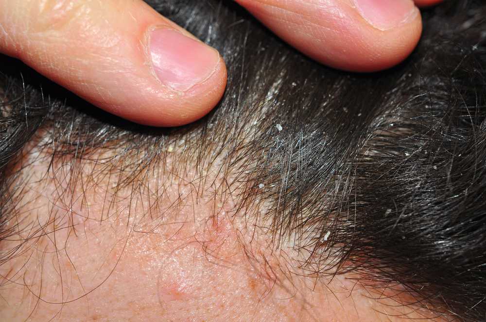 Viêm nhiễm da đầu làm hư hại chân tóc