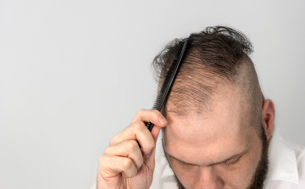 Rụng tóc hói đầu để lâu khó chữa